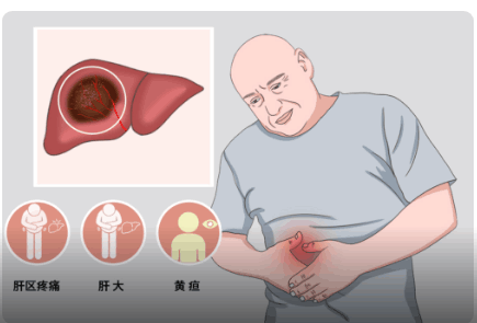 肝癌的中期癥狀